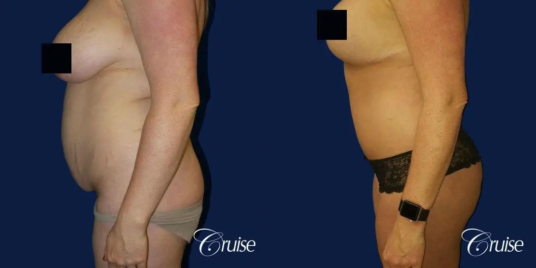 Best tummy tucks dr cruise - Before and After 2