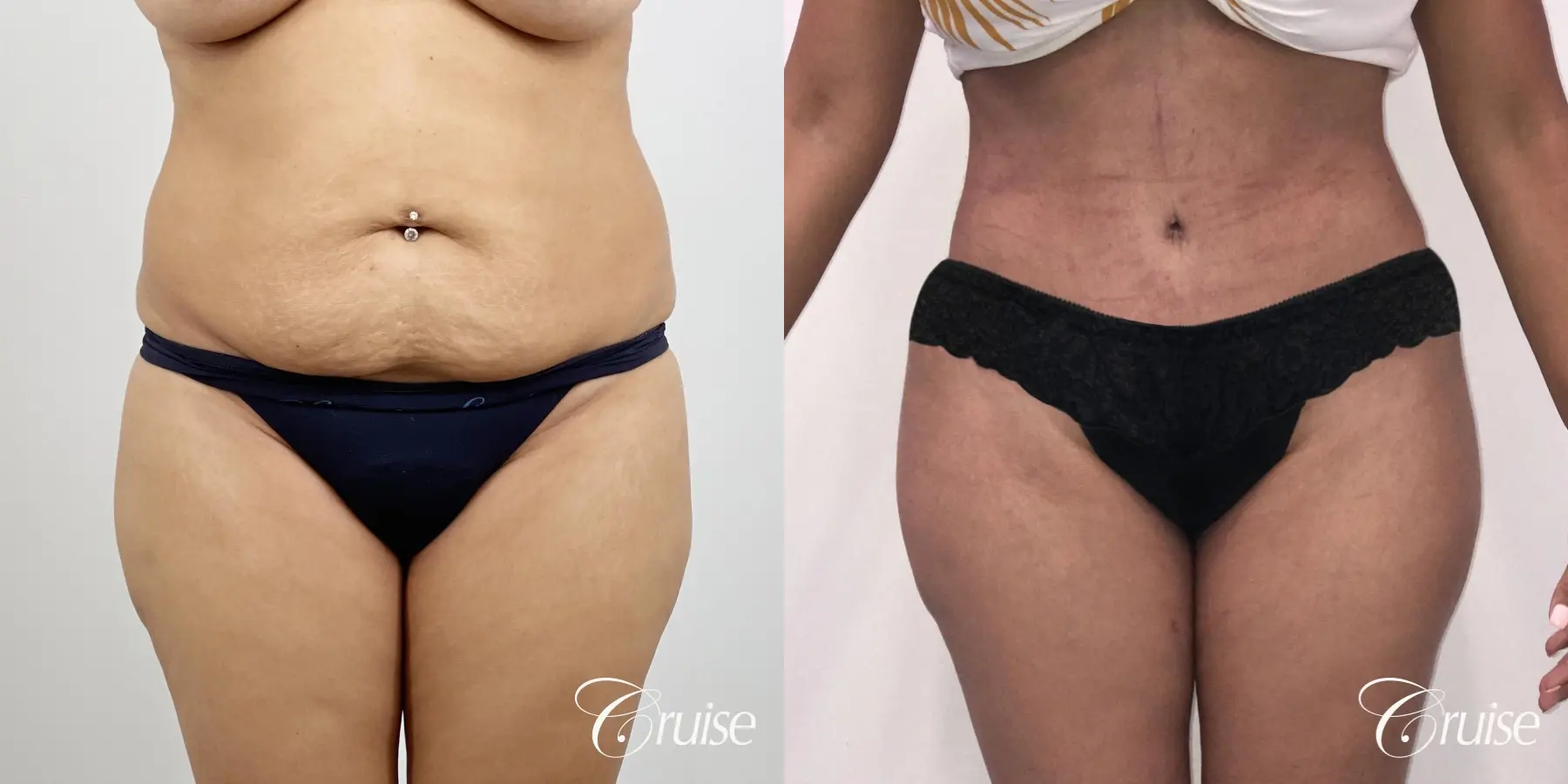 Tummy Tuck: Patient 76 - Before and After 1