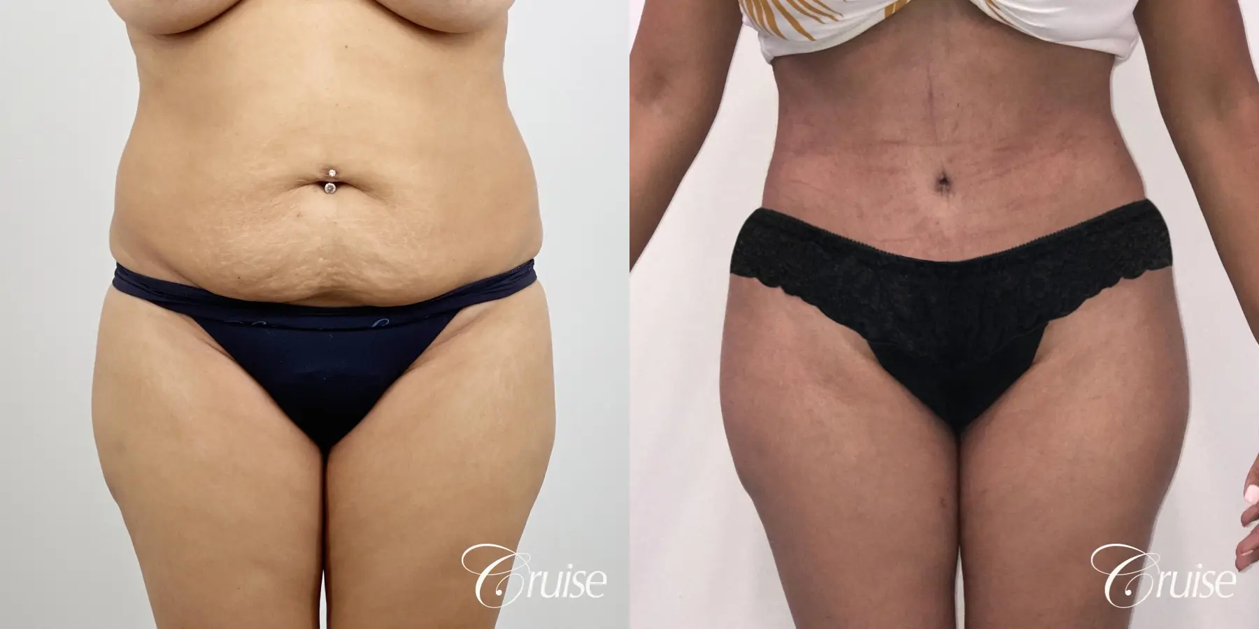 Tummy Tuck: Patient 82 - Before and After 1