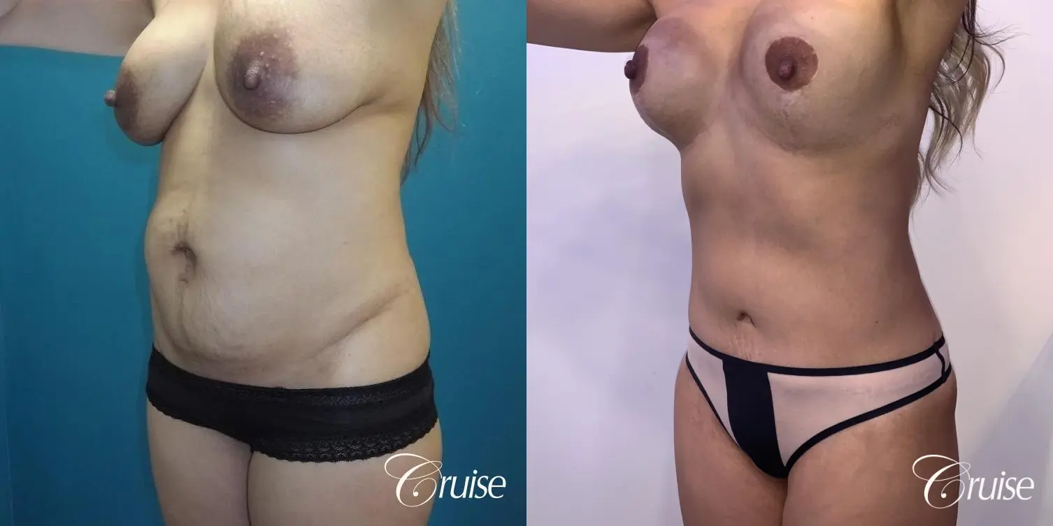 Standard Tummy Tuck, Liposuction with BBL, & Breast Implants: 36 Yr Old Mom - Before and After 3