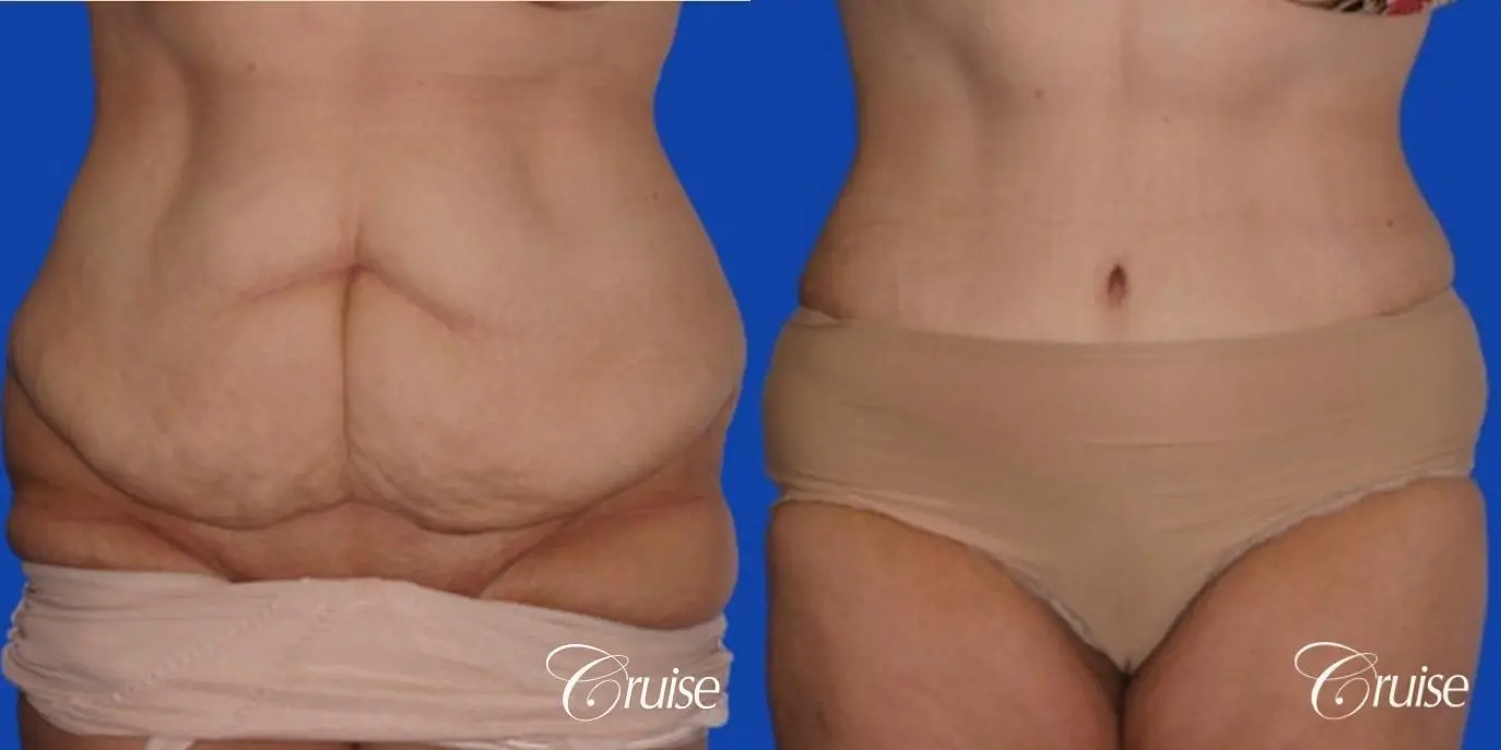 best tummy tuck on weight loss female pictures - Before and After 1