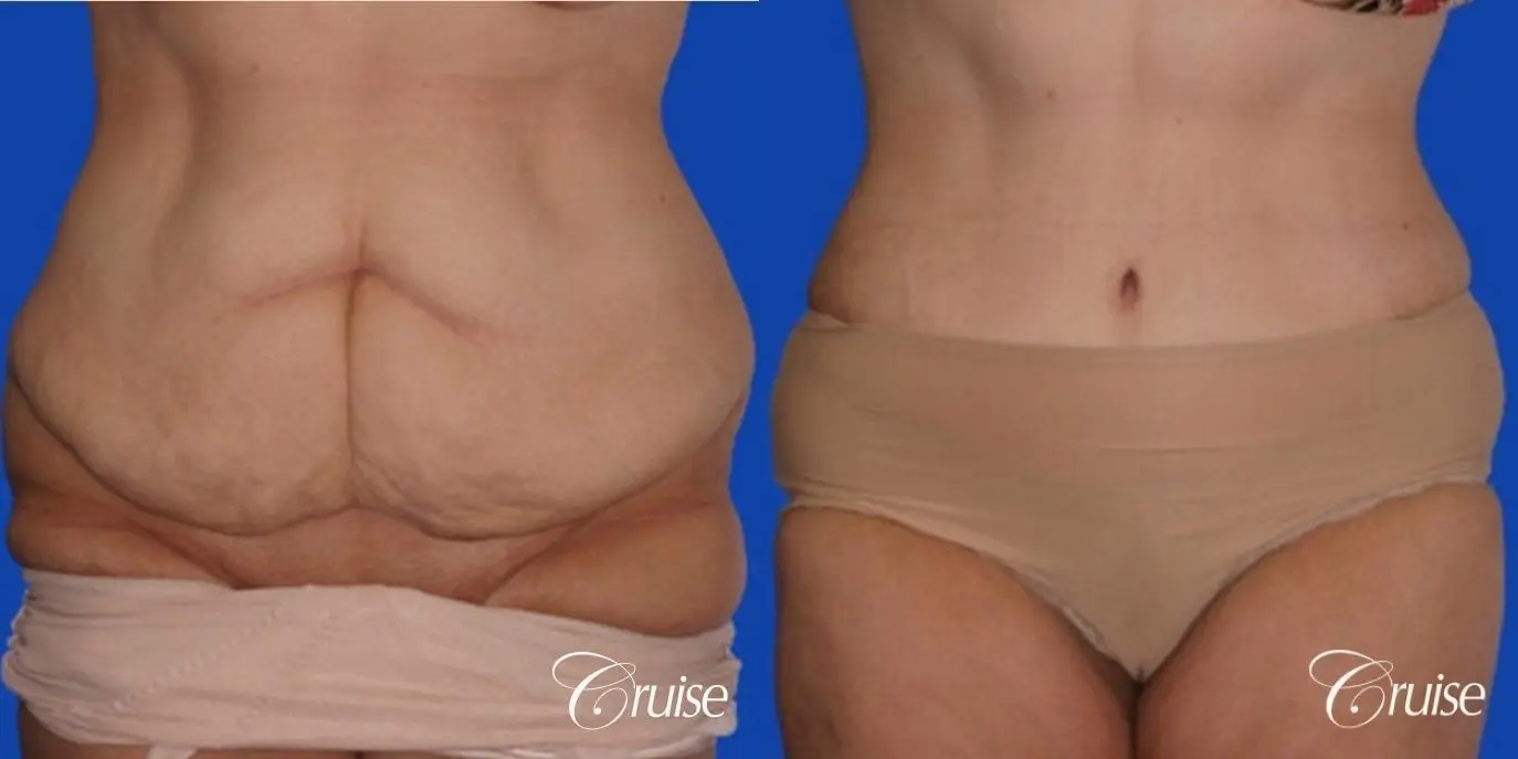 Tummy Tuck Before and After