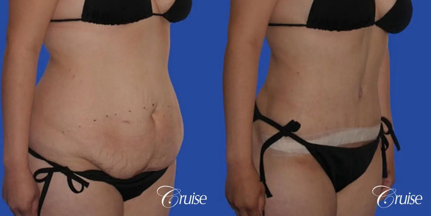 large tummy tuck on young girl - Before and After 2