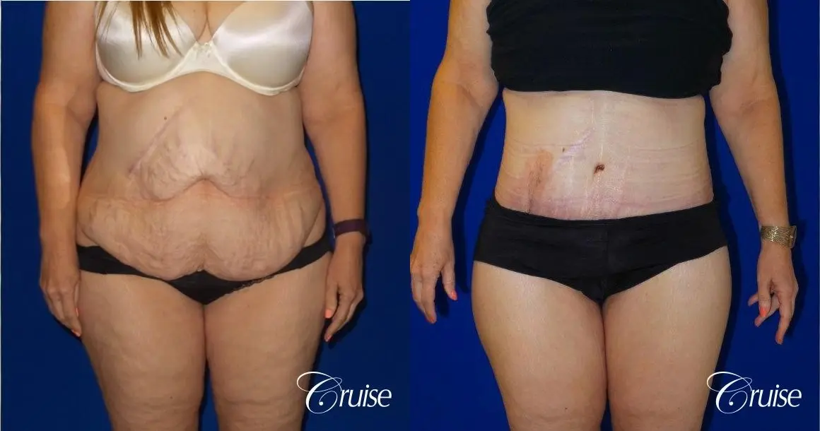 Tummy Tuck Circumferential Incision - Before and After  