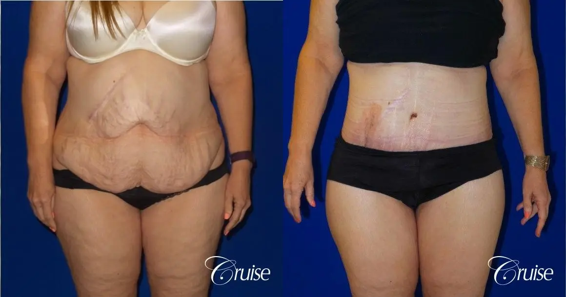 Tummy Tuck Circumferential Incision - Before and After 1