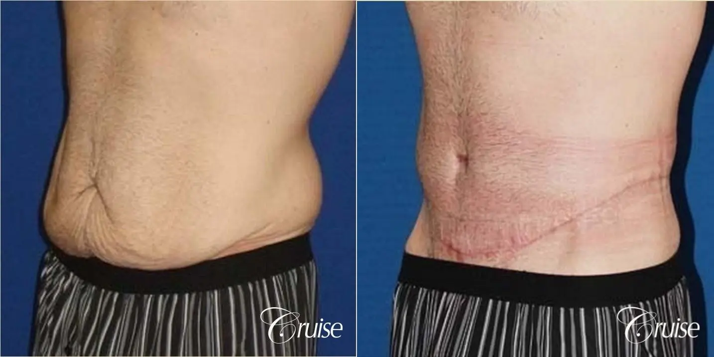 Best male circumferential tummy tuck - Before and After 4