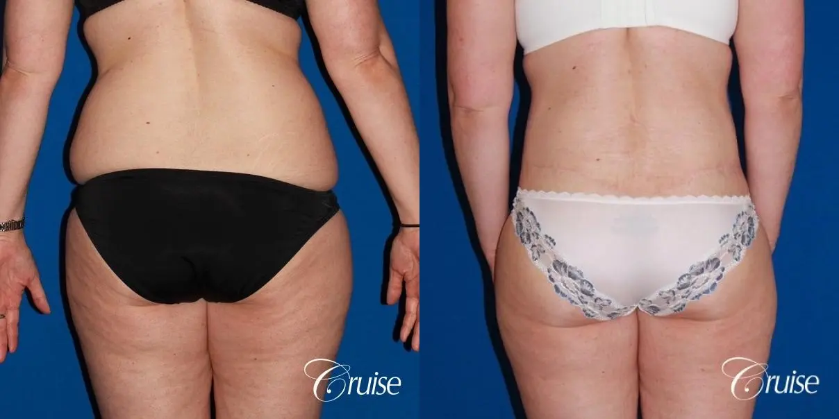 35 Yr Old Female  with Circumferential Tummy Tuck & Liposuction - Before and After 4