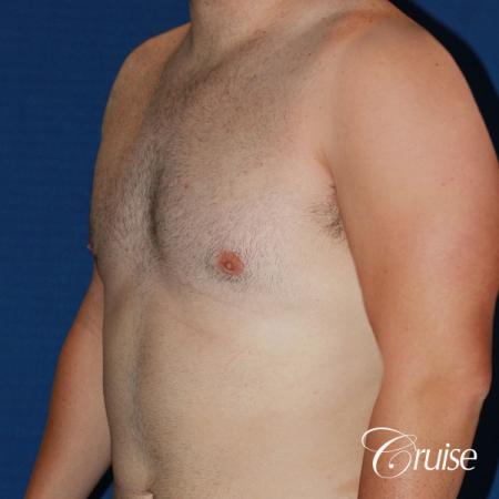 moderate chest gynecomastia and liposuction flanks - After Image 2