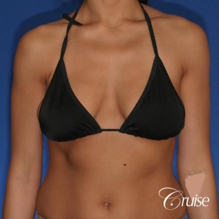 best breast lift anchor with silicone augmentation in Orange County - Before and After Image 4
