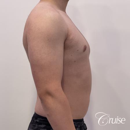 Gynecomastia: Patient 123 - After 5
