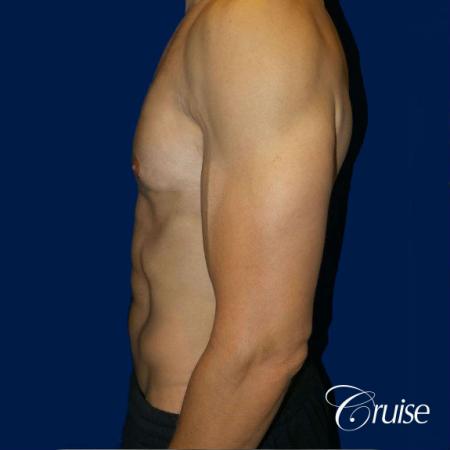 Moderate Gynecomastia -Pedicle - After Image 2