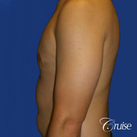 gyne before and after photos orange county ca - After Image 3