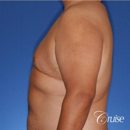 free nipple graft gynecomastia results - After Image 3