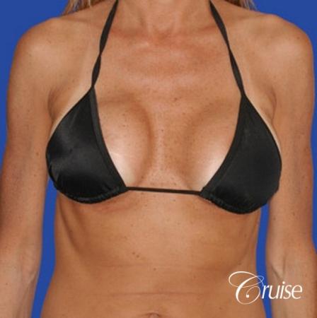 breast lift on one side only before and after pictures - Before and After Image 4