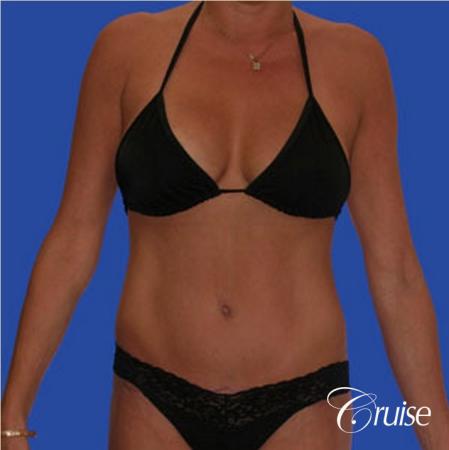 mommy makeover with best breast lift anchor with saline implants - After Image 4
