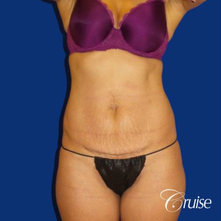 tuck tummy incision extended before