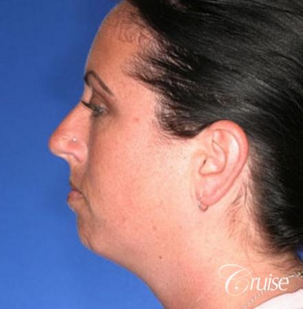 before and after photos of female chin implant - Before Image 2
