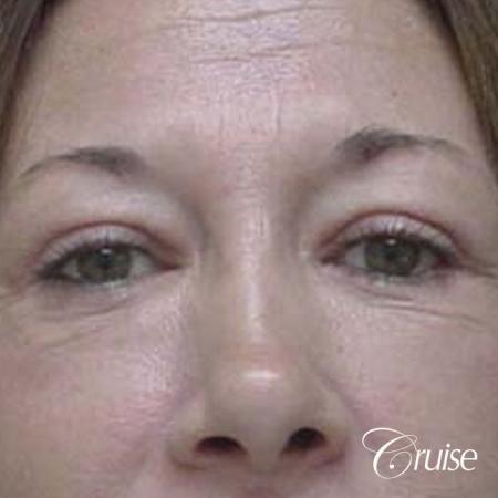 Fat Transfer - Lower Lids, Tear Trough - After Image