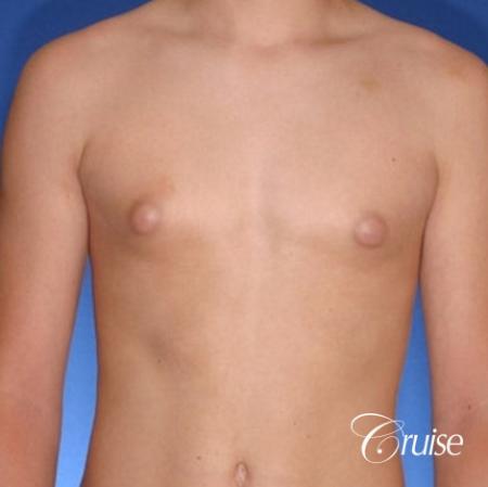 teenage gynecomastia with puffy nipple - Before 1