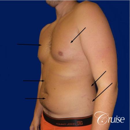Best before and after lipo photos of guys - Before Image 2