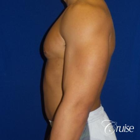 bodybuilder with gynecomastia - After Image 3