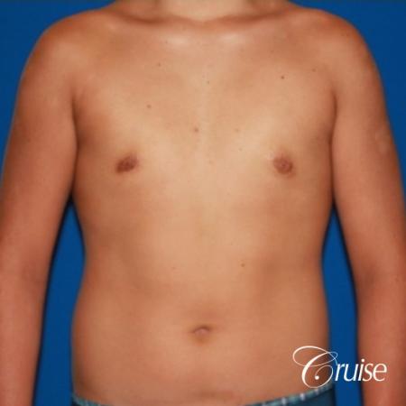 severe puffy nipple on teenager - After Image 1