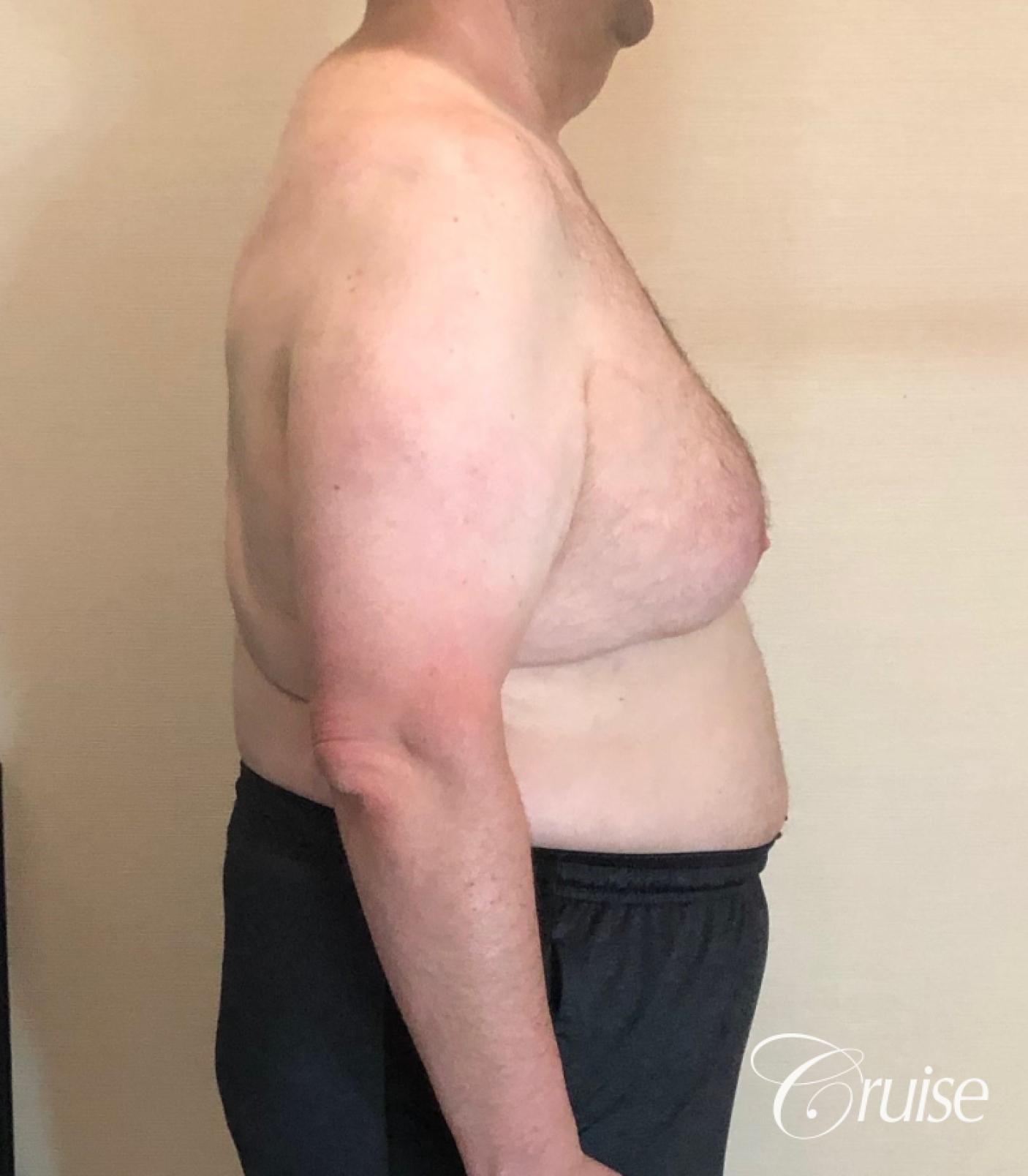 Gynecomastia Type 6; Circumferential Upper Body Lift; Liposuction to Upper Abdominal Rib Fat, Posterior Arms, Upper Back and Flanks - Before 2