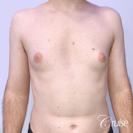 Gynecomastia: Patient 128 - Before 1