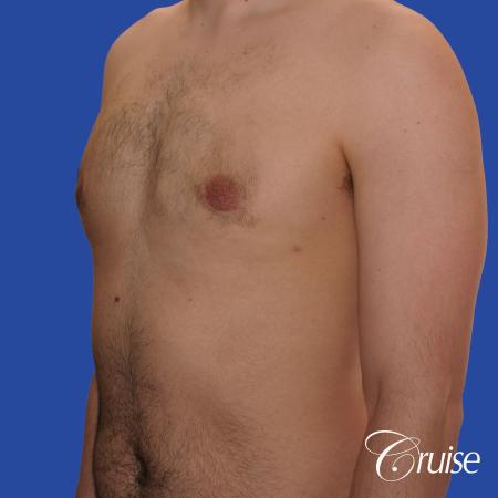 20 year old with moderate gynecomastia - After Image 3
