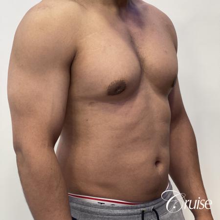 gynecomastia surgery - After 5