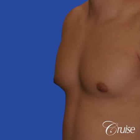 mild gynecomastia with puffy nipple and areola incision - Before Image 2