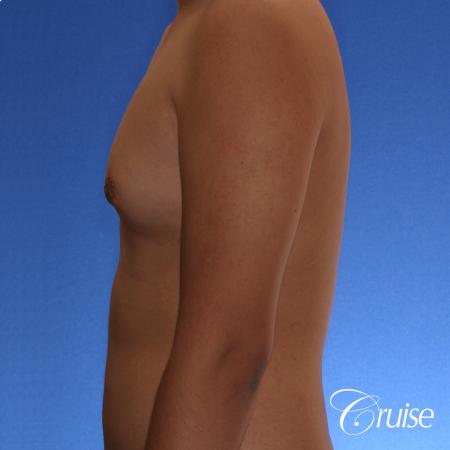 best gynecomastia surgery with plastic surgeon, Dr. Cruise - Before Image 2
