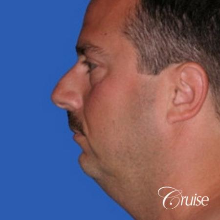 terino square jaw implant after best chin augmentation - Before Image 2