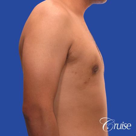 mild gynecomastia standard PA areola incision - After Image 4