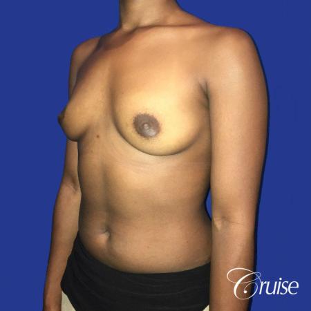 Breast Augmentation surgery Dr. Cruise - Before Image 2