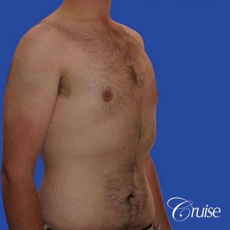 weight loss patient with gynecomastia - After Image 3