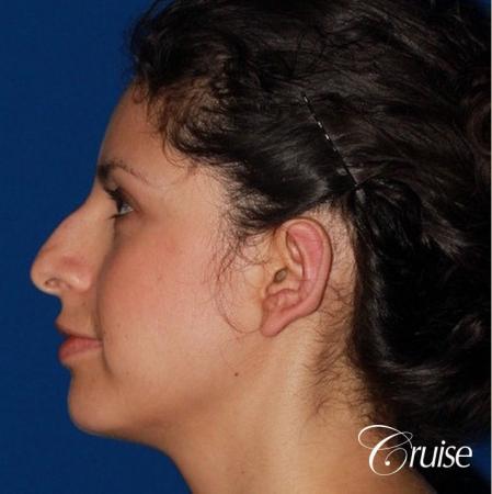 best otoplasty with natural appearance on female - After Image 2