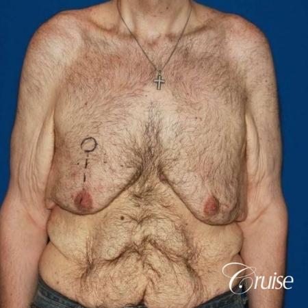 severe weight loss gynecomastia upper body lift - Before Image 1