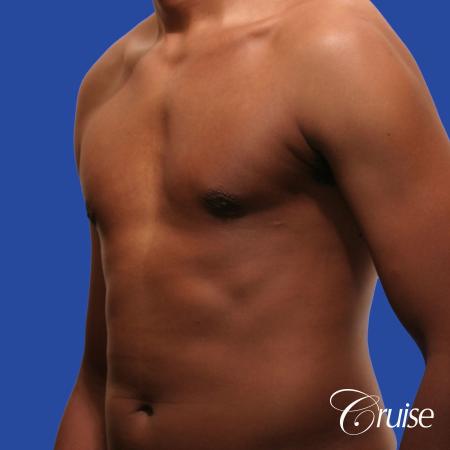 young body builder has puffy nipple and gets gynecomastia surgery - After Image 3