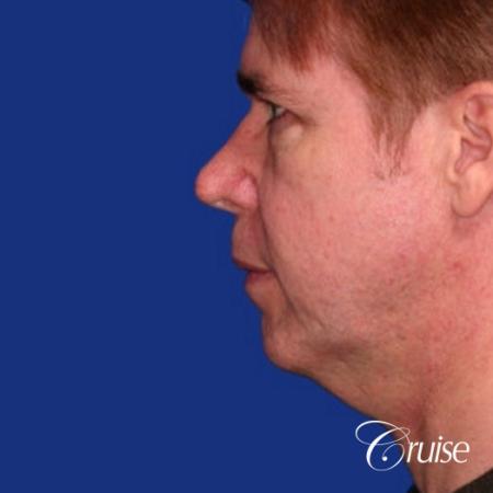 male with best scar for chin implant - Before and After Image 2