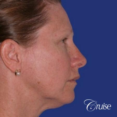 52 year old with chin augmentation and facelift - Before and After Image 3