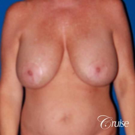 best breast lift revision with saline 270cc - Before Image 1