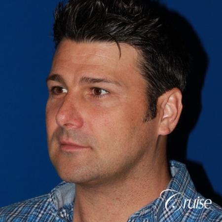 best medium terino square implant before and after pictures - After Image 3