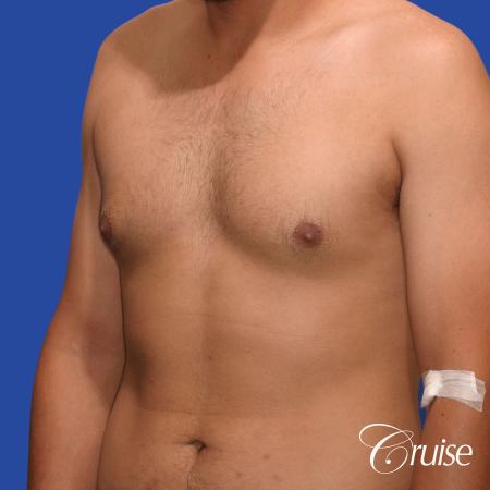 mild gynecomastia standard PA areola incision - Before Image 3