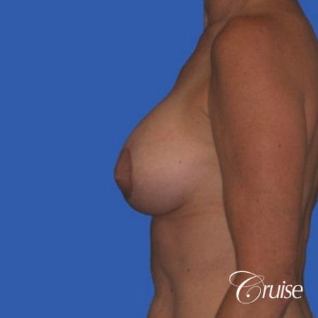 best breast lift donut pictures on mature woman - After Image 2