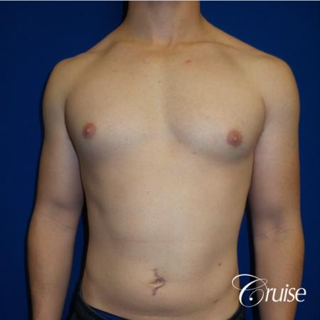 Adult gynecomastia before and after photos - Before Image 1