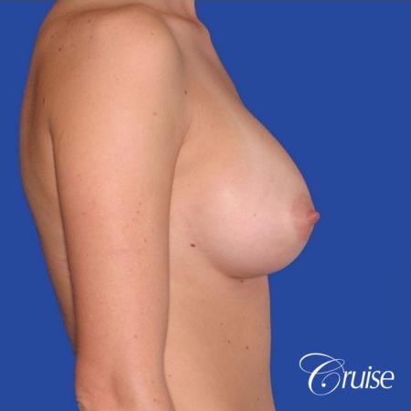 best pictures of breast revision for capsular contracture - After Image 2