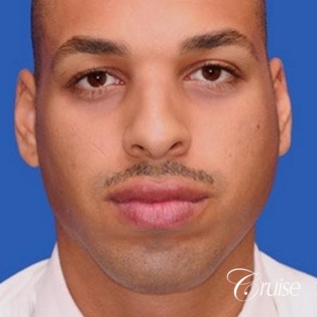 male patient with best pictures of chin implant - After Image 1