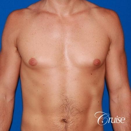 mild gyne on athletic adult - Before Image 1