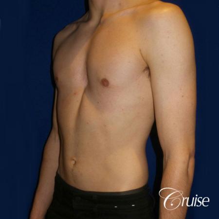 Top Gynecomastia Specialist Dr. Cruise - After Image 3